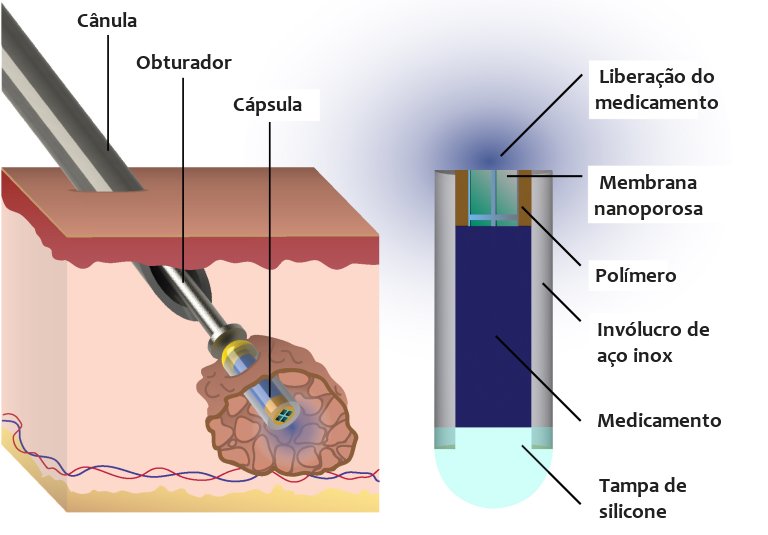 Cpsula implantvel libera medicamento de forma automtica