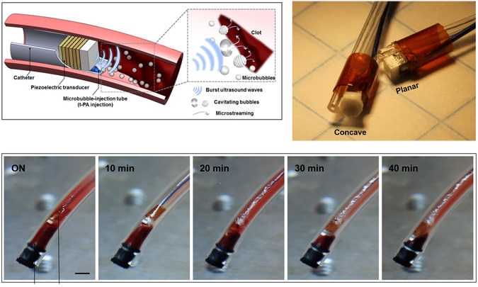 Broca ultrassnica destri cogulos da trombose