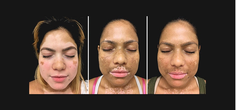 Vitiligo  virtualmente eliminado com terapia combinada