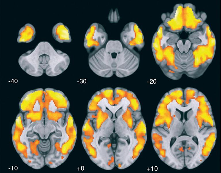 Brasileiros validam mtodo para diferenciar Alzheimer de outras demncias