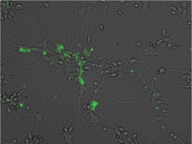 Acmulo de placas amiloide no explica incidncia de Alzheimer