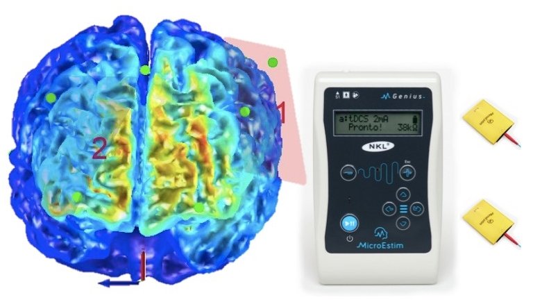 Estimulao eltrica refora terapia motora de paciente com Parkinson