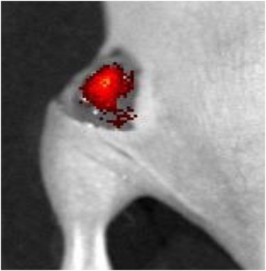 Spray fluorescente destaca tumor para que cirurgio possa retir-lo completamente