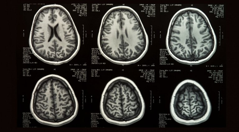 Banco de dados cria mtrica para medir o desenvolvimento cerebral