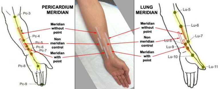 Acupuntura reduz drasticamente dor de cabea tensional