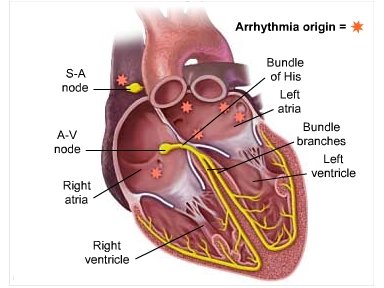 Mdicos recomendam alterao no tratamento inicial da fibrilao atrial