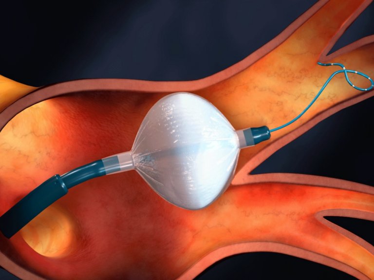 Mdicos recomendam alterao no tratamento inicial da fibrilao atrial