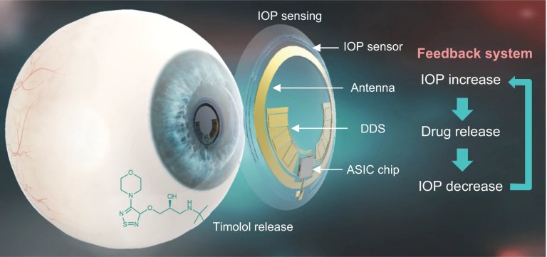 Lente de contato inteligente monitora e trata o glaucoma