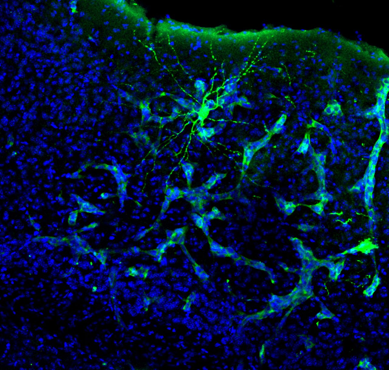 Tumores cerebrais hackeiam a comunicao entre os neurnios