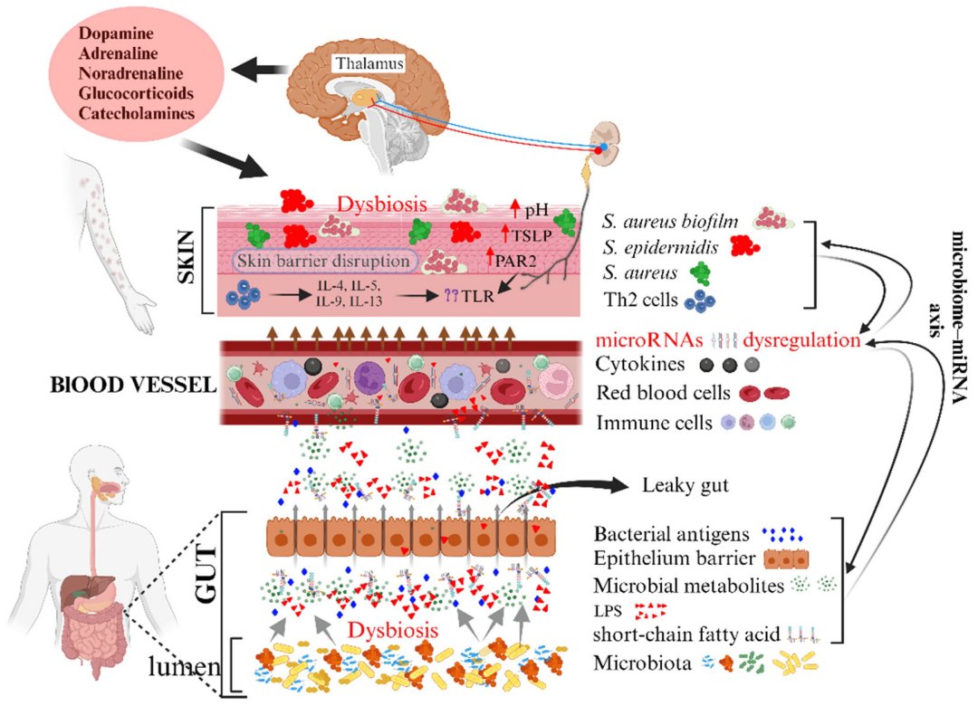 Conexo intestino-pele  fator central na dermatite atpica