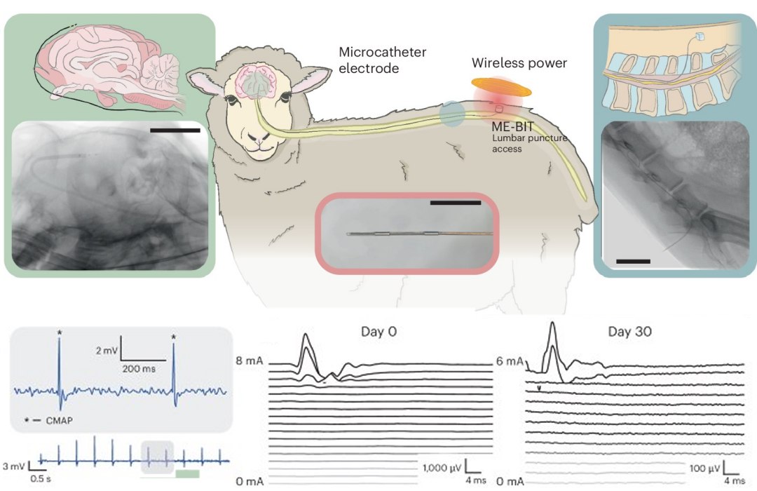 Interface neural minimamente invasiva dispensa abrir o crnio