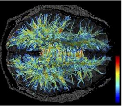 Parkinson evolui de forma diferente nas mulheres e nos homens