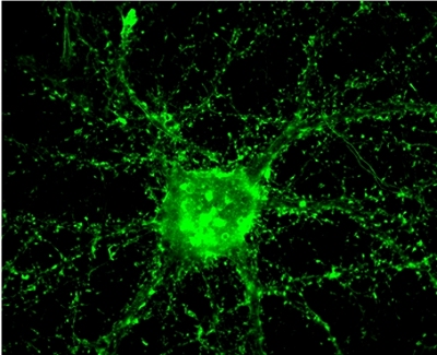 Brasileiros descobrem caminho para tratar Alzheimer