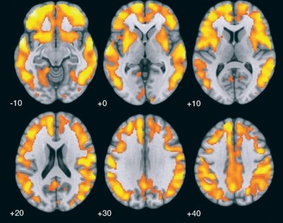 Medicamento pode prevenir Alzheimer, mas farmacutica no quer estud-lo