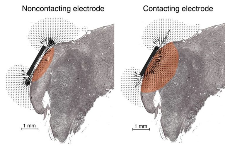 Implantes auditivos de ltima gerao so flexveis