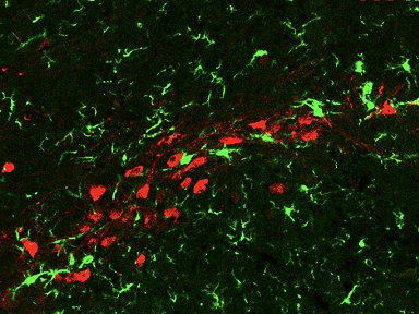 Teste de pele pode identificar doena de Parkinson