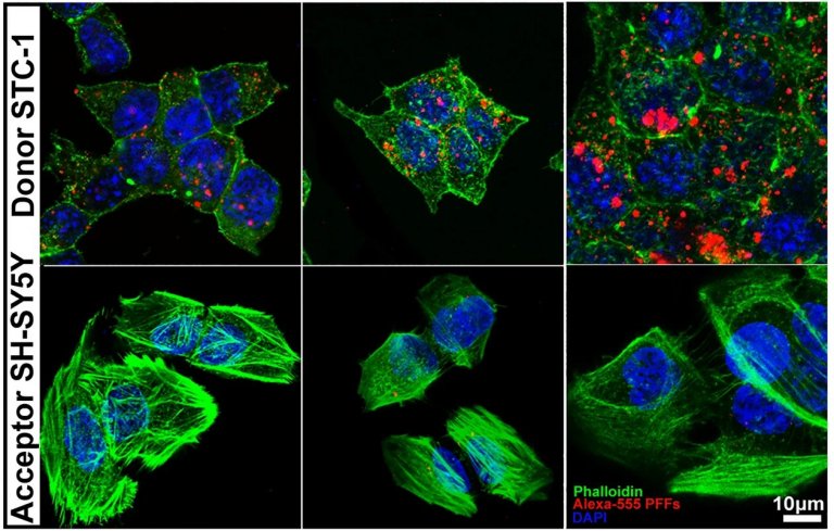 Descobrimos as bactrias intestinais que protegem e as que aumentam risco de Alzheimer