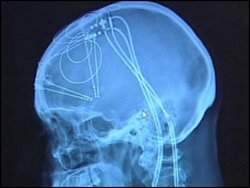 Cirurgia pioneira cura depresso aguda de britnica