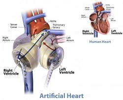 Corao totalmente artificial salva vida de paciente