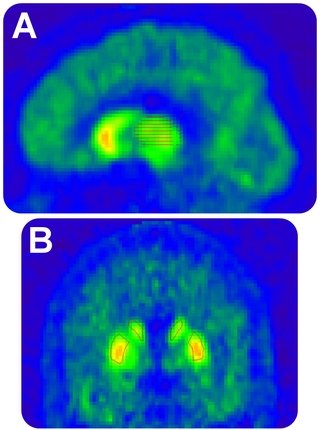 Criatividade e esquizofrenia usam mesmos canais cerebrais