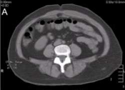 Gordura abdominal  a mais perigosa para doenas do corao