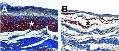 Hidrogel injetvel regenera corao aps infarto