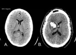 Derrame cerebral emite sinal de perigo antes de ocorrer