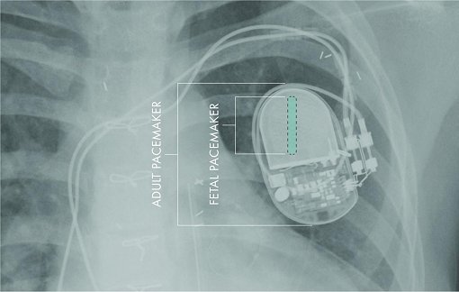 Marca-passos miniaturizado ser implantado em bebs no tero