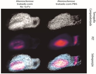 Nanocpsulas removem pior parte do colesterol