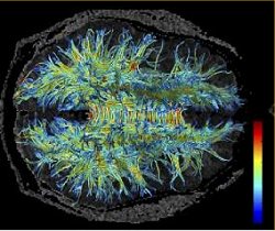 Plasticidade cerebral continua ocorrendo na terceira idade