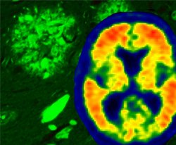 Protenas tau, e no amiloides, podem ser causa de Alzheimer