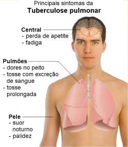 Mdicos recebem treinamento para novo tratamento da tuberculose